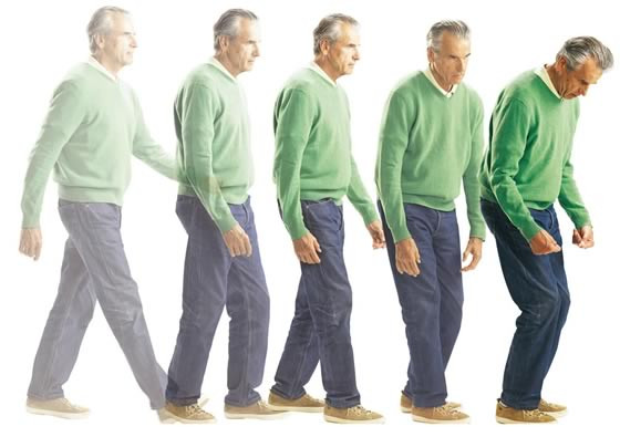 Dấu hiệu cảnh báo bệnh Parkinson dau-hieu-canh-bao-benh-parkinson